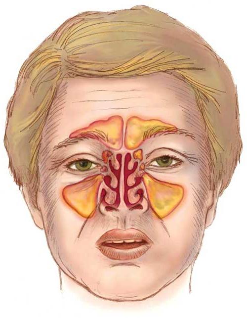 симптоми третмана синуситисом