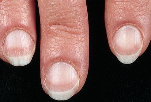 Да ли су болести ноктију опасне на рукама?